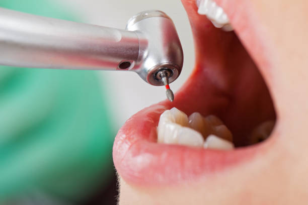 Best Emergency Root Canal Treatment in Novi, MI